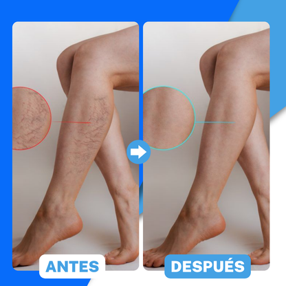 1+1 GRATIS VENOSPRAY™ | ELIMINA LAS VARICES EN 12 DÍAS